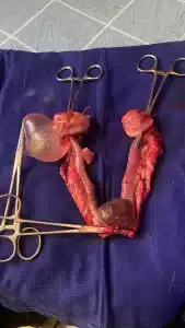 Picture showing ovaries and uterus with cysts and tumors.